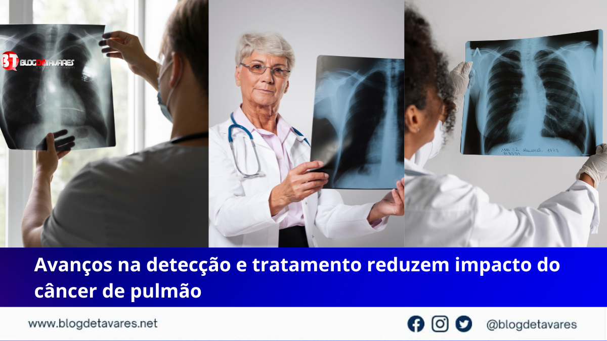 Avanços na detecção e tratamento reduzem impacto do câncer de pulmão 