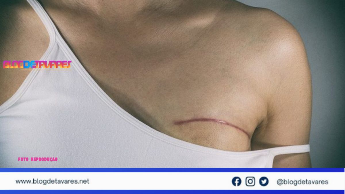 Nova lei garante fisioterapia no SUS a pacientes que retirarem mama 